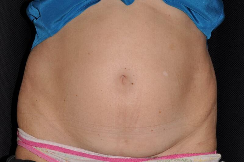 Abdominoplasty Before & After Image