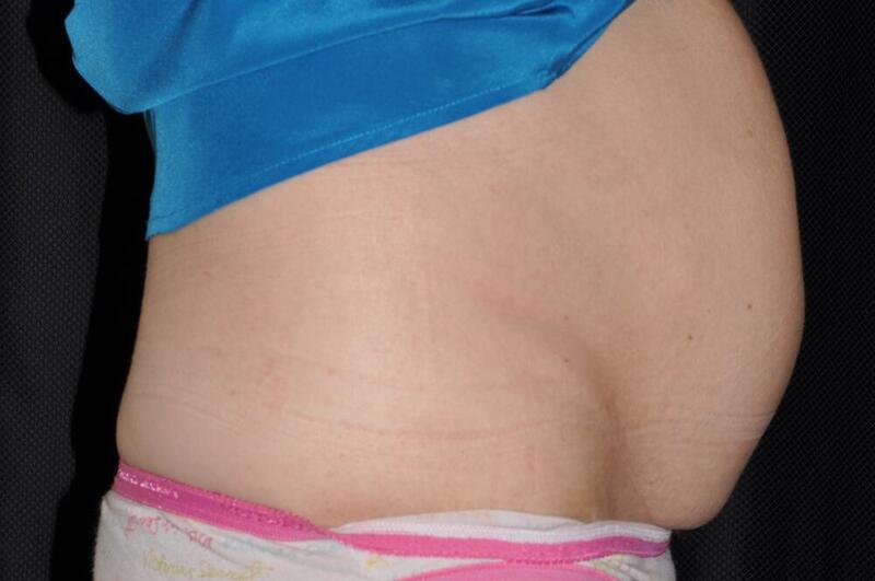 Abdominoplasty Before & After Image