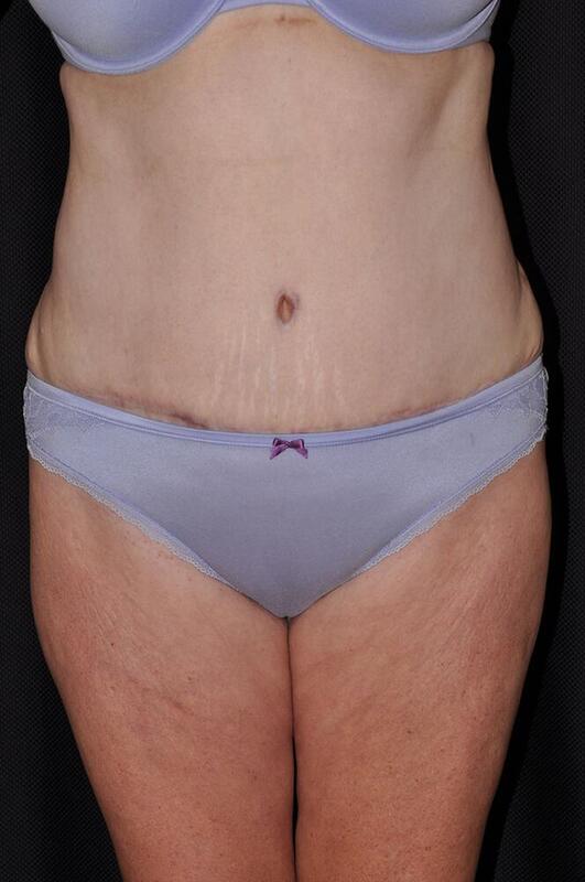 Abdominoplasty Before & After Image