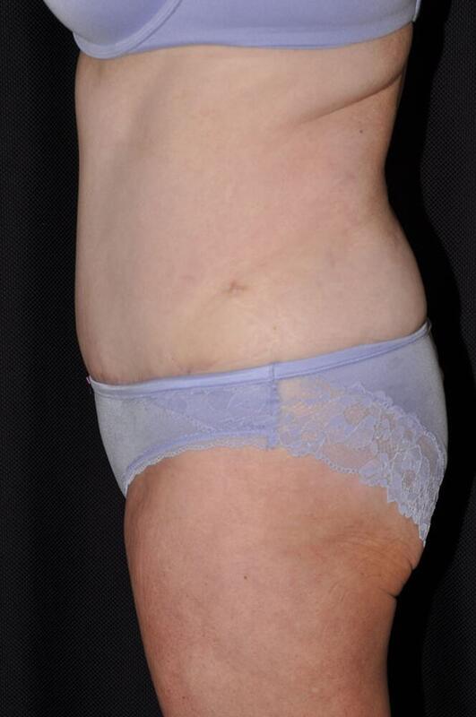 Abdominoplasty Before & After Image