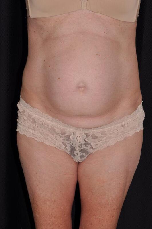 Abdominoplasty Before & After Image