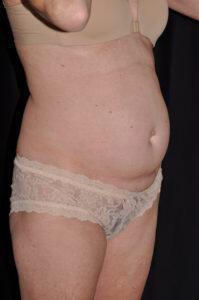 Abdominoplasty Before & After Image