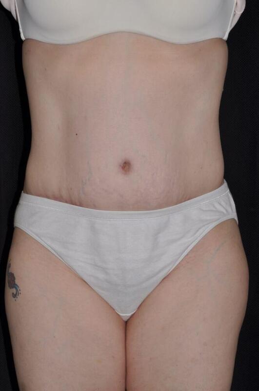 Abdominoplasty Before & After Image