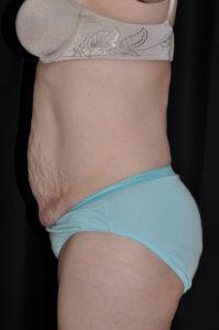 Abdominoplasty Before & After Image