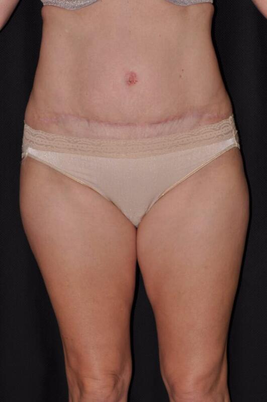 Abdominoplasty Before & After Image