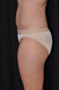 Abdominoplasty Before & After Image