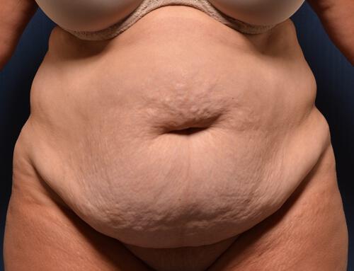 Abdominoplasty Before & After Image