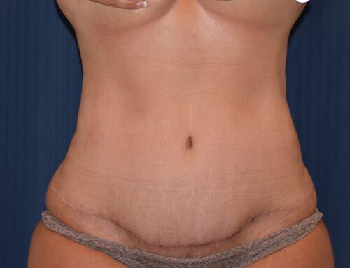 Abdominoplasty Before & After Image