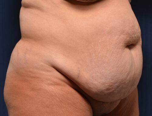 Abdominoplasty Before & After Image