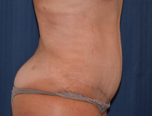 Abdominoplasty Before & After Image