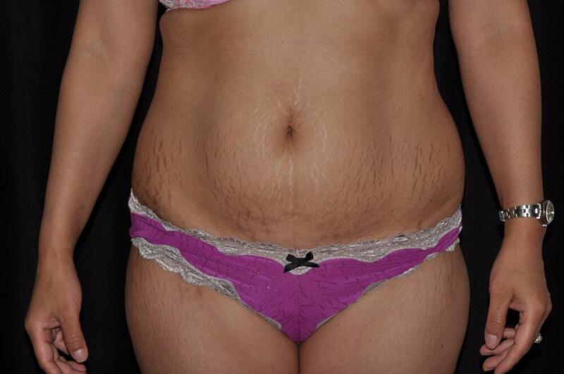 Abdominoplasty Before & After Image