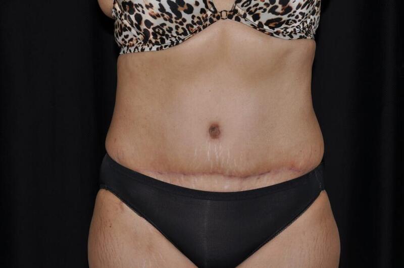 Abdominoplasty Before & After Image