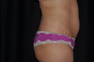 Abdominoplasty Before & After Image