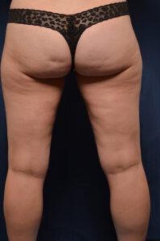 Body Lift Before & After Image