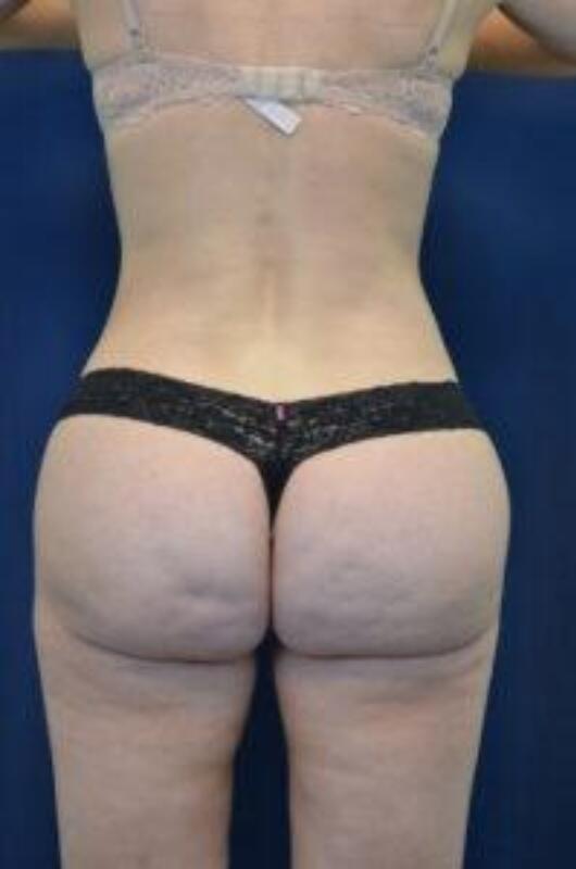 Body Lift Before & After Image