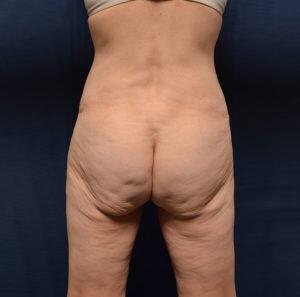 Body Lift Before & After Image