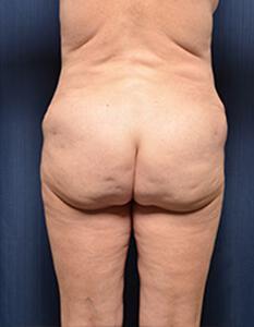 Brazilian Butt Lift Before & After Image