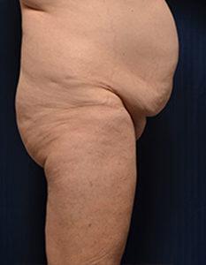 Brazilian Butt Lift Before & After Image