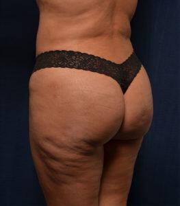 Brazilian Butt Lift Before & After Image