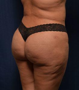 Brazilian Butt Lift Before & After Image