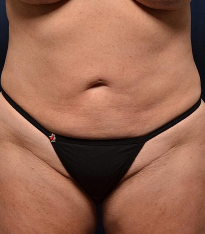 Brazilian Butt Lift Before & After Image