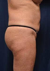 Brazilian Butt Lift Before & After Image