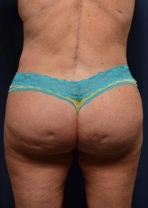 Brazilian Butt Lift Before & After Image