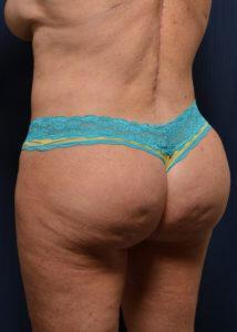 Brazilian Butt Lift Before & After Image