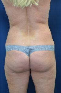 Brazilian Butt Lift Before & After Image