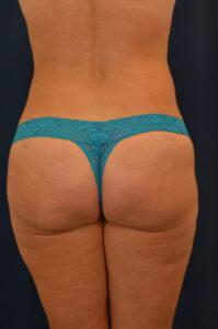 Brazilian Butt Lift Before & After Image