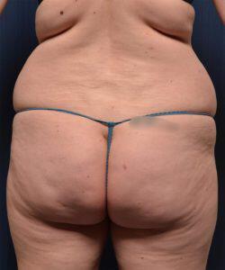 Brazilian Butt Lift Before & After Image