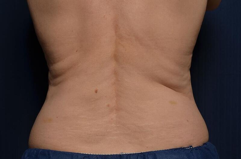 CoolSculpting Elite Before & After Image