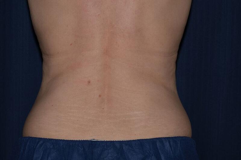 CoolSculpting Elite Before & After Image