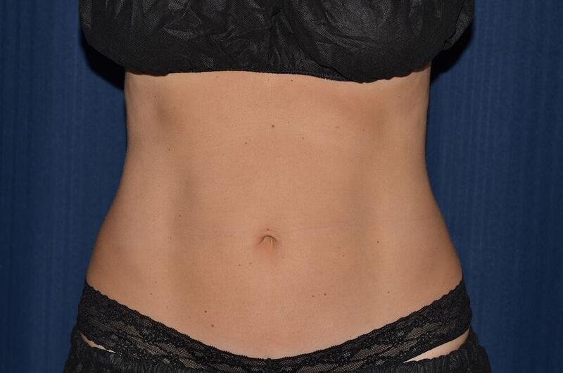 CoolSculpting Elite Before & After Image