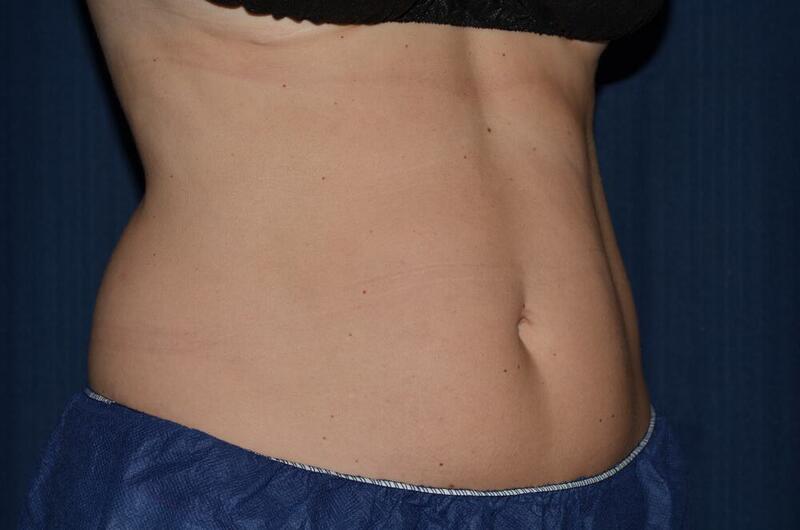 CoolSculpting Elite Before & After Image