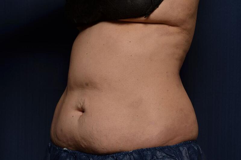 CoolSculpting Elite Before & After Image