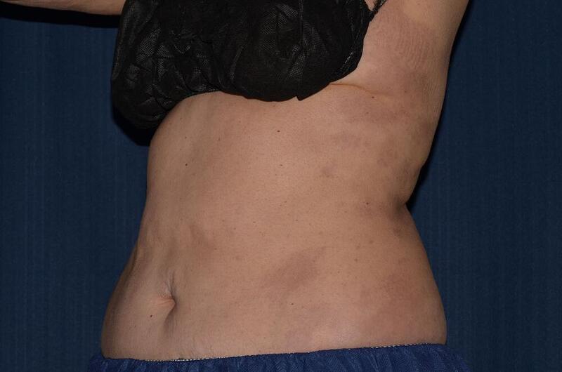 CoolSculpting Elite Before & After Image