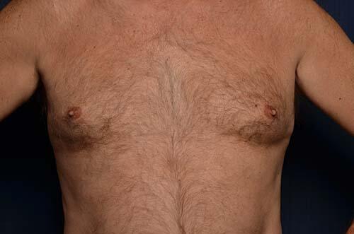 CoolSculpting Elite Before & After Image