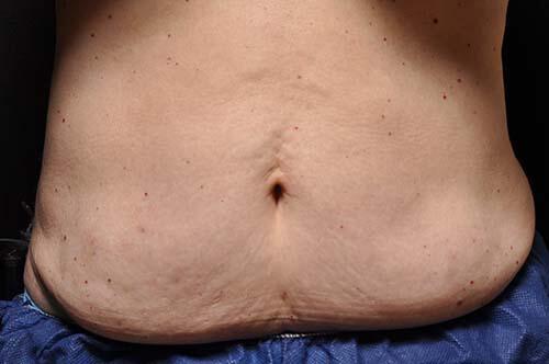 CoolSculpting Elite Before & After Image