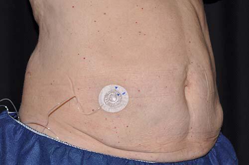 CoolSculpting Elite Before & After Image