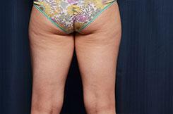 CoolSculpting Elite Before & After Image