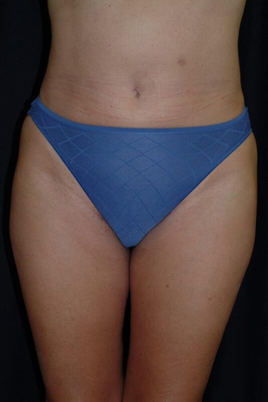 Liposuction Before & After Image