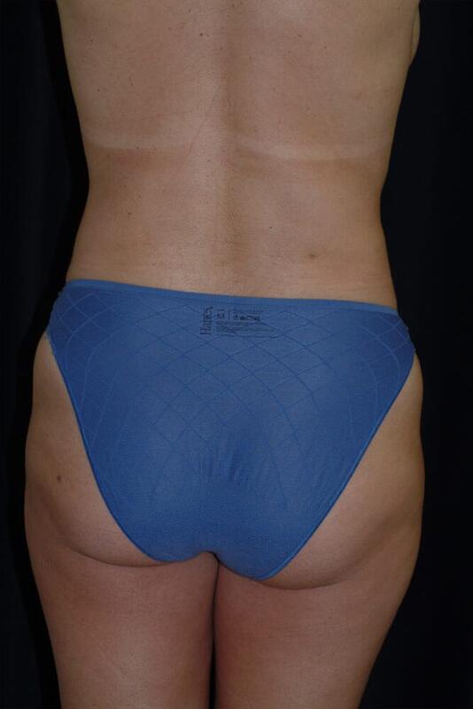 Liposuction Before & After Image