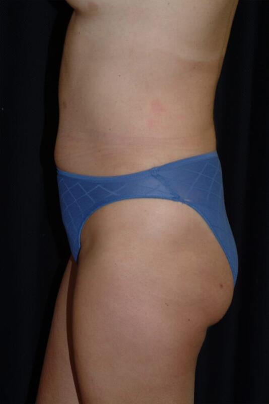 Liposuction Before & After Image