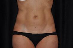 Liposuction Before & After Image