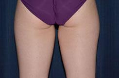 Thigh Lift Before & After Image