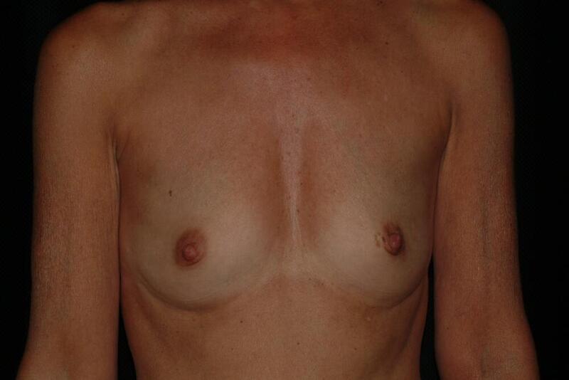 Breast Augmentation Before & After Image