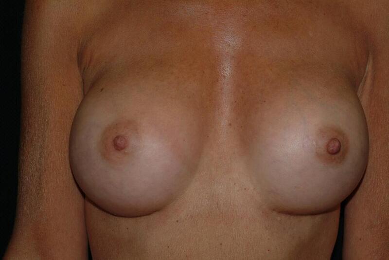 Breast Augmentation Before & After Image