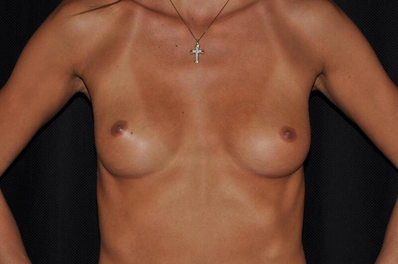 Breast Augmentation Before & After Image