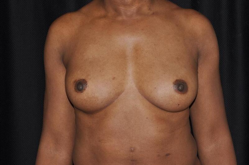 Breast Augmentation Before & After Image